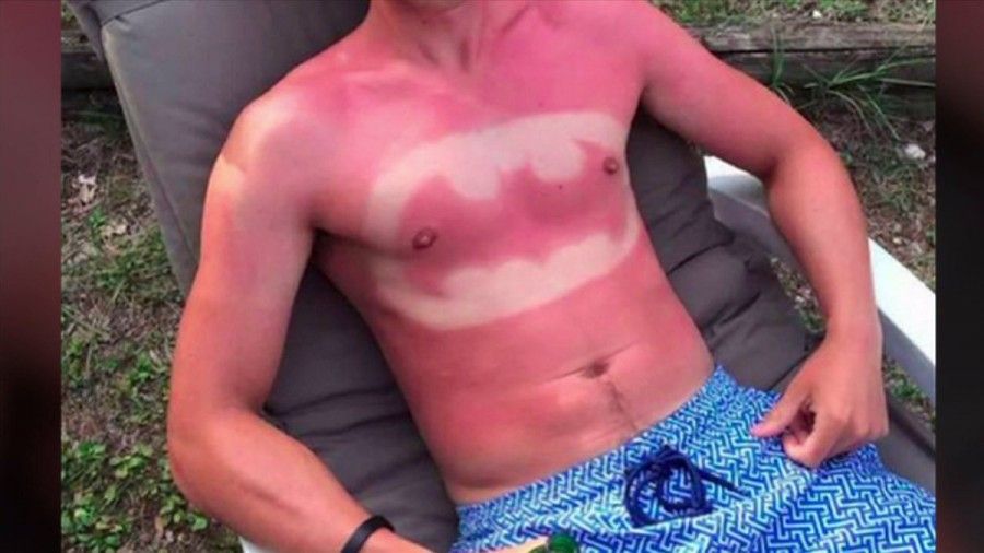 sunburn-art