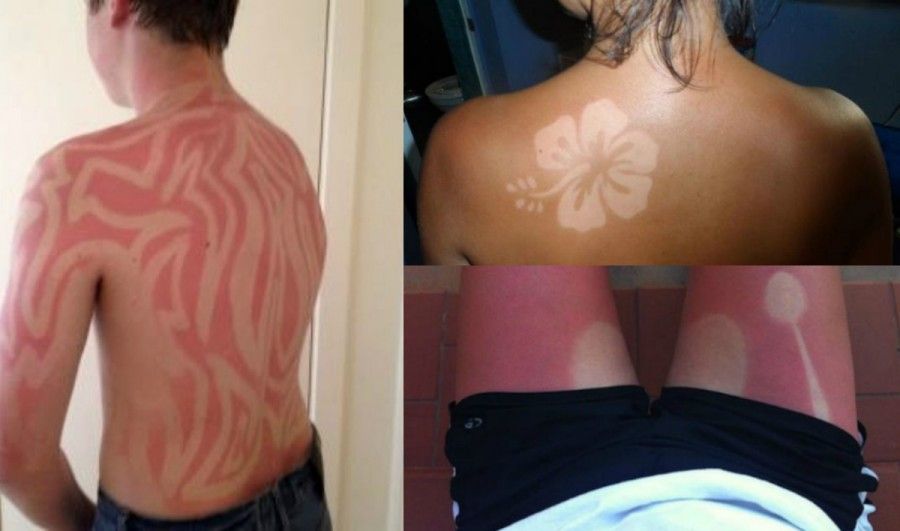 sunburn-art