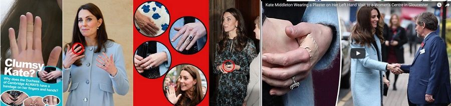 I cerotti sulle mani di Kate Middleton