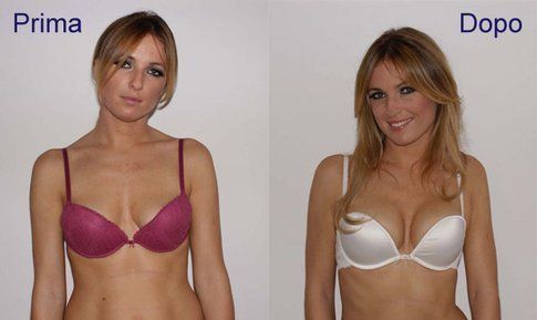 Prima e dopo il Bra Fitting