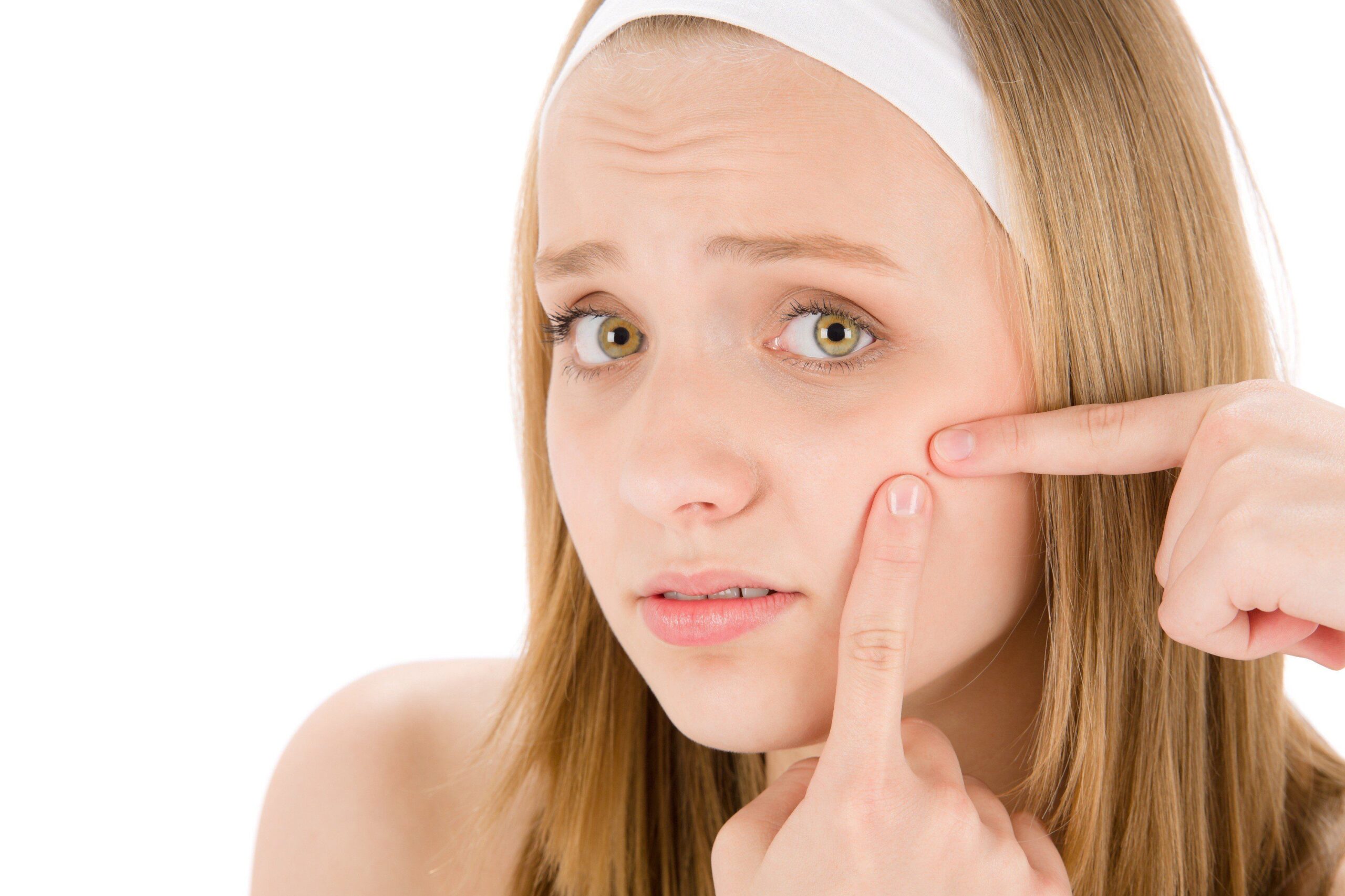 Bicarbonato di sodio per combattere l’acne!