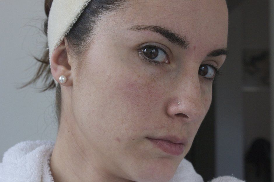 Couperose che rimedi usi? Bigodino