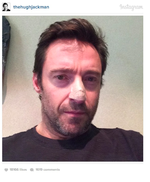 Hugh Jackman operato per cancro al naso