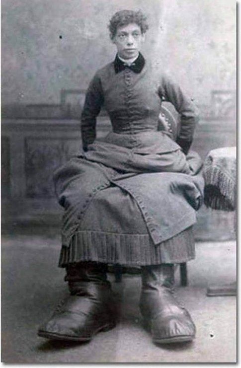 Fannie Mills, “The Ohio Big Foot Girl”