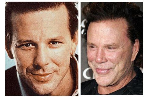 Mickey Rourke prima e dopo la chirurgia