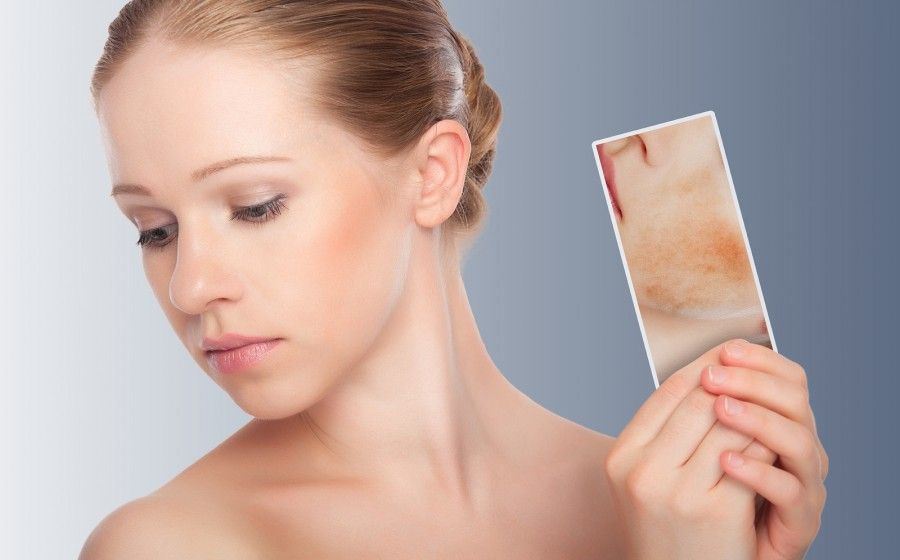 Acne in gravidanza come attenuare i segni sul viso