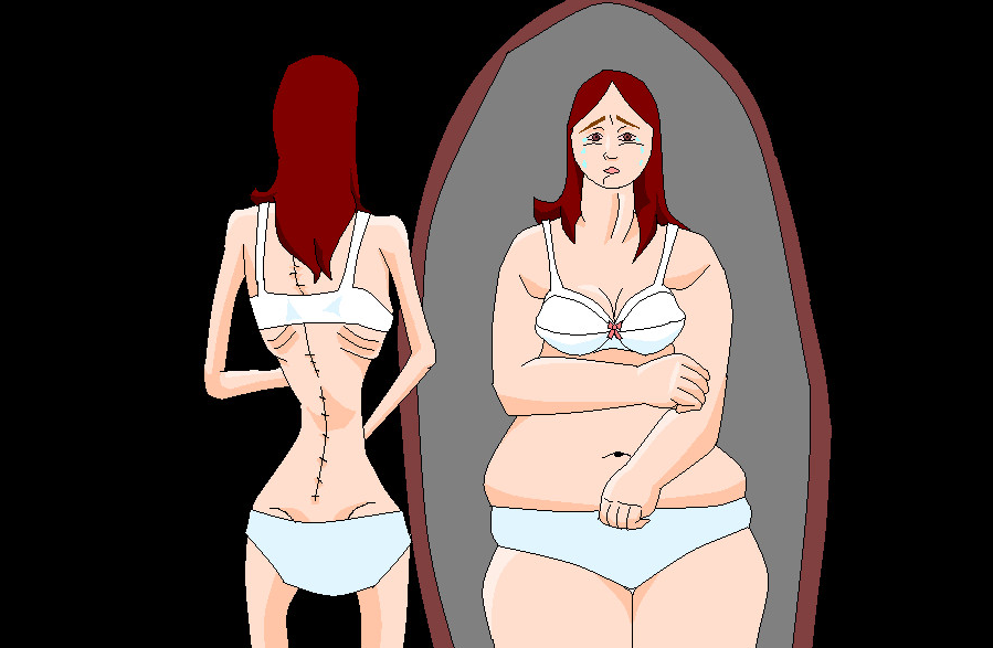 anoressia