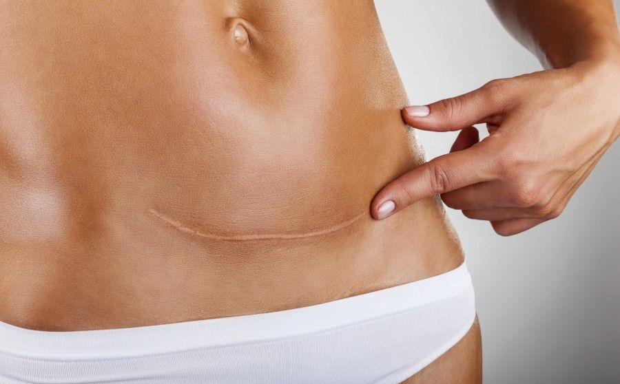 Closeup of woman belly with a scar from a cesarean section