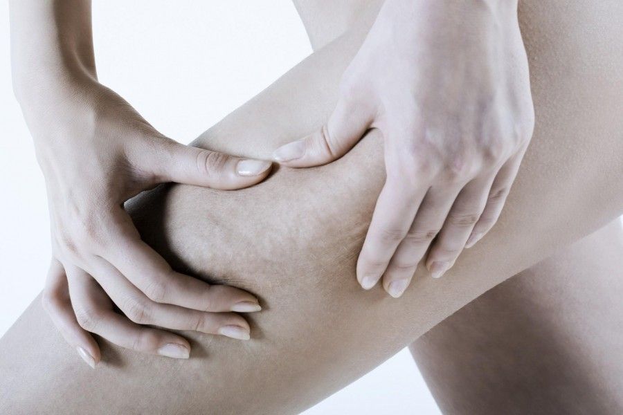 cellulite-e-ritenzione-idrica-analogie-e-differenze_9132a0ed773f986fd264dedb62869d28