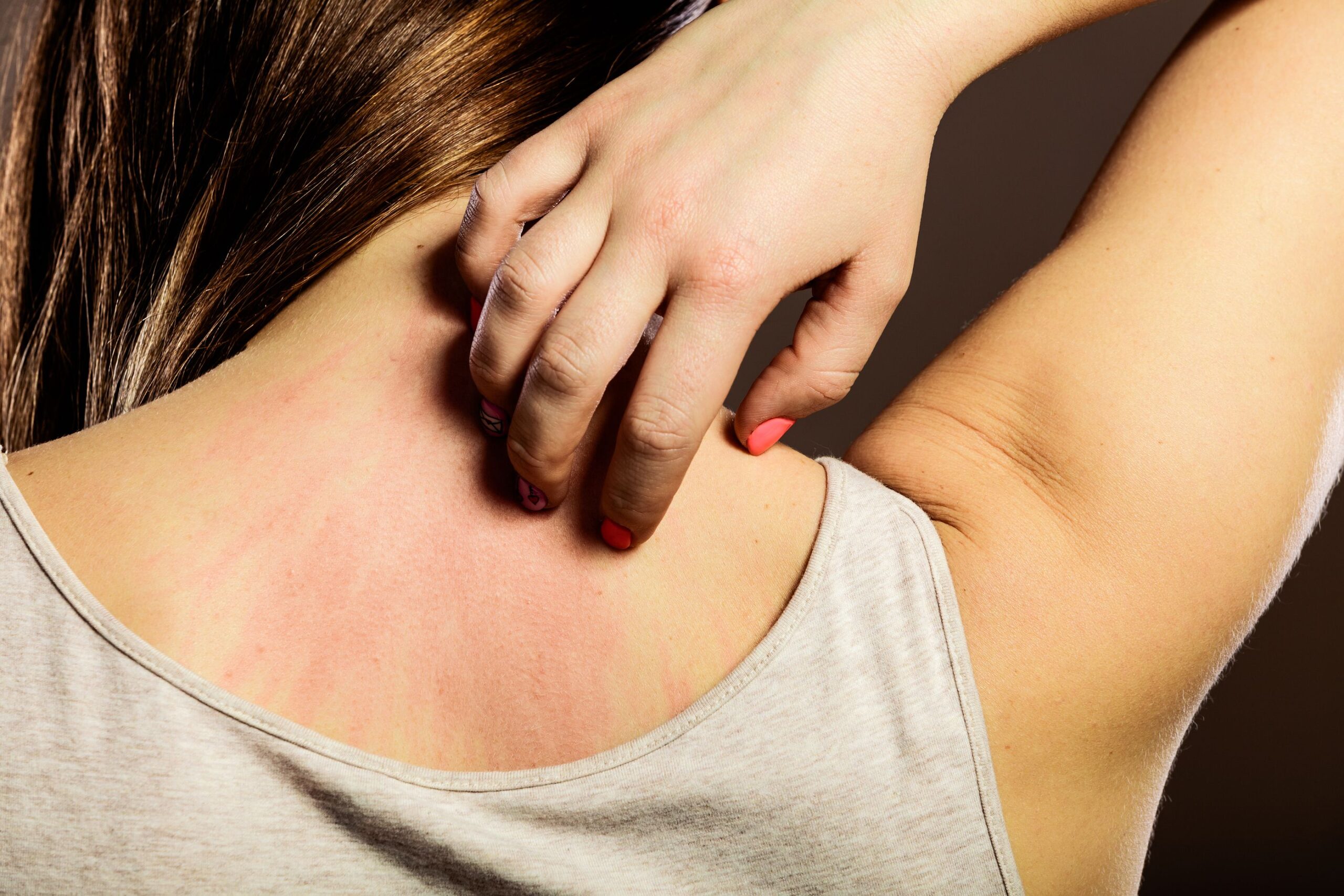 Eczema, cos’è? Cause e sintomi