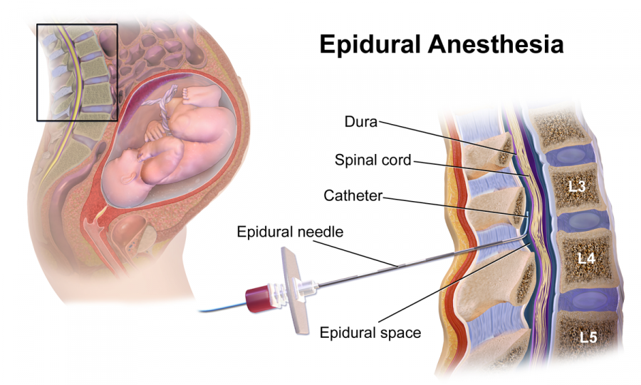 Epidural_Anesthesia