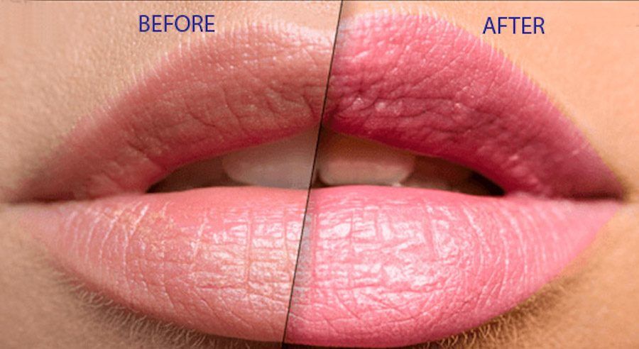 lip plumper