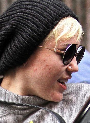 Miley Cyrus al naturale mostra chiari problemi di acne.