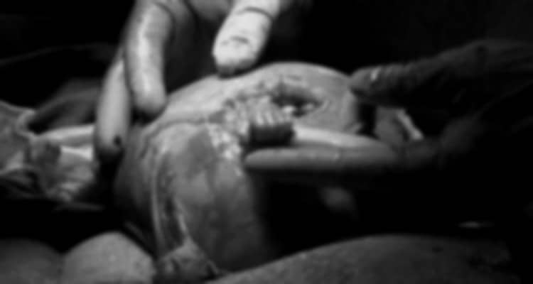 Un feto di 21 settimane stringe il dito del medico durante l’operazione
