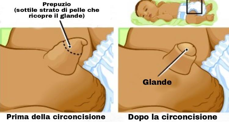 Circoncidere o no il maschietto? Leggete qui!