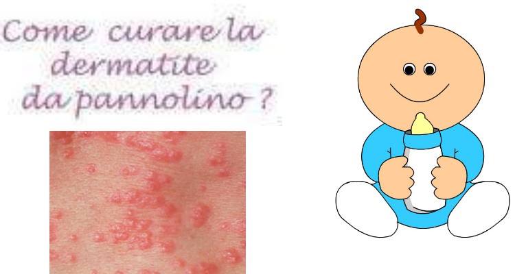 Cause, rimedi e prevenzione per la dermatite da pannolino