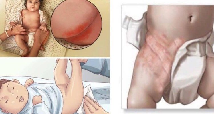 Dermatite da pannolino? Cause, rimedi e prevenzione.