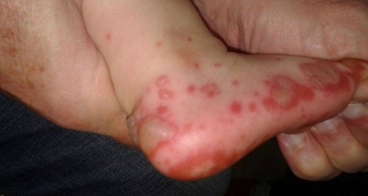 “Sindrome bocca-mani-piedi”: come riconoscerla e come curarla