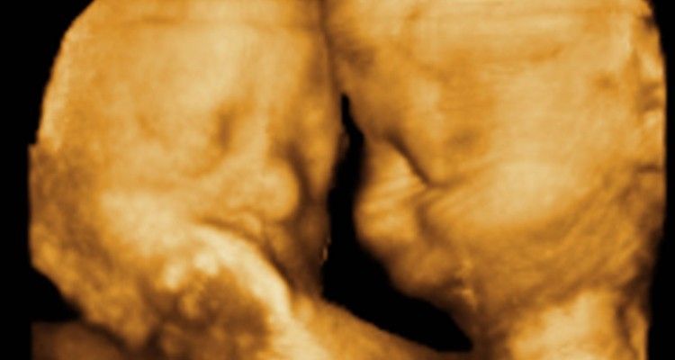 Come restare incinta di due gemelli?