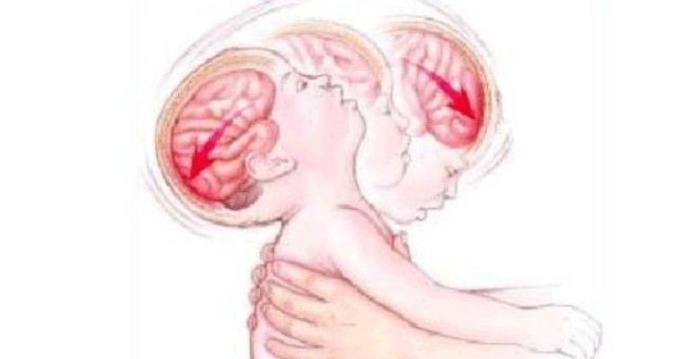 Cos’è la sindrome del bambino scosso: cause, rischi e come evitarla