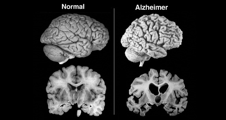 Come fermare la demenza o l’Alzheimer prima che si manifestino i sintomi