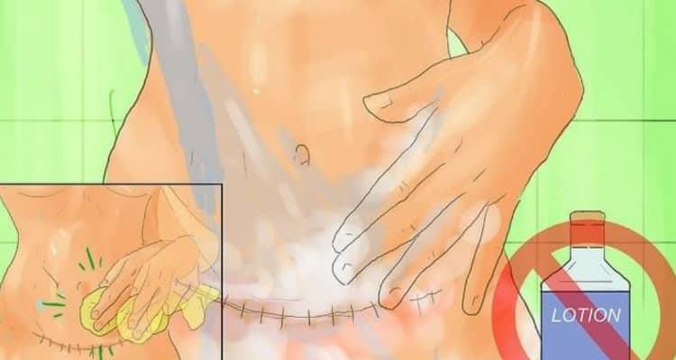 7 cose che dovreste sapere sulla cicatrice del cesareo