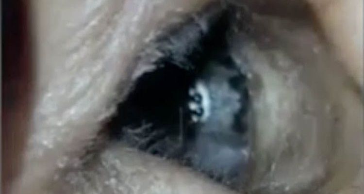 Una spiacevole scoperta nell’orecchio