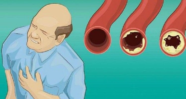 I cibi che puliscono le arterie e prevengono le malattie cardiovascolari