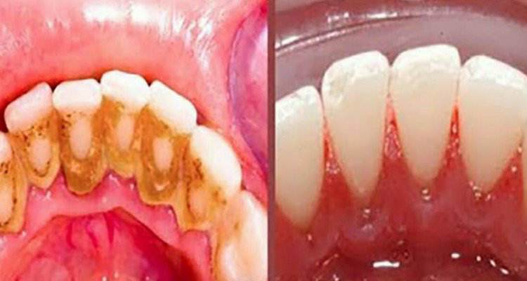 Trucco per rimuovere la placca dai denti
