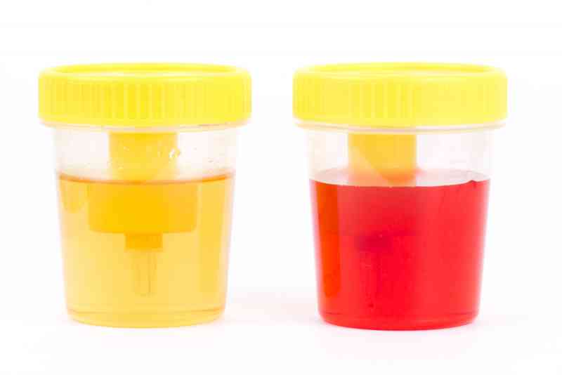 Il colore delle urine dice molto sul nostro stato di salute Bigodino