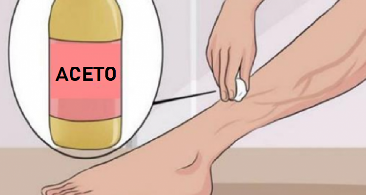 Tre ingredienti per dire addio alle vene varicose
