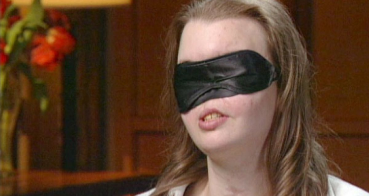 Ha perso metà viso 19 anni fa. Finalmente i medici le hanno dato un motivo per rimuovere la maschera