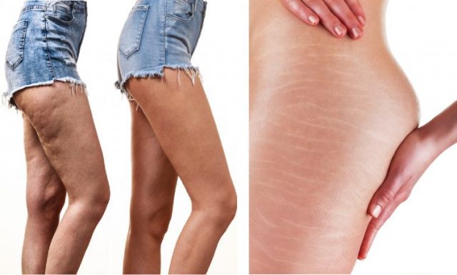 ridurre la cellulite