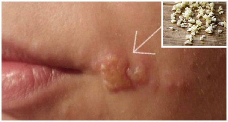 Come rimuovere l’herpes in 24 ore