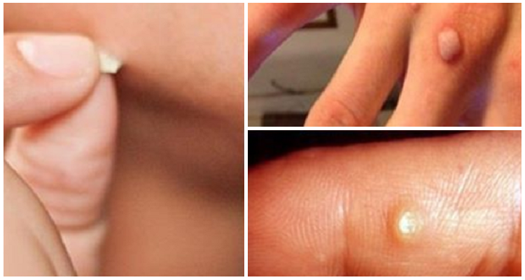 Come eliminare le verruche in modo naturale