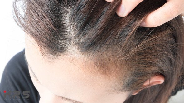 Perdita capelli post parto: perché succede e cosa fare