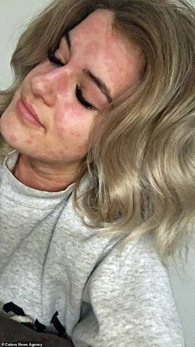 "Sono allergica al freddo", il dramma di una 21enne canadese