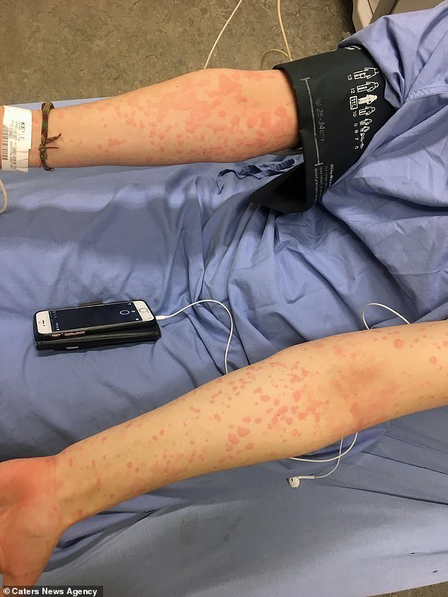 "Sono allergica al freddo", il dramma di una 21enne canadese