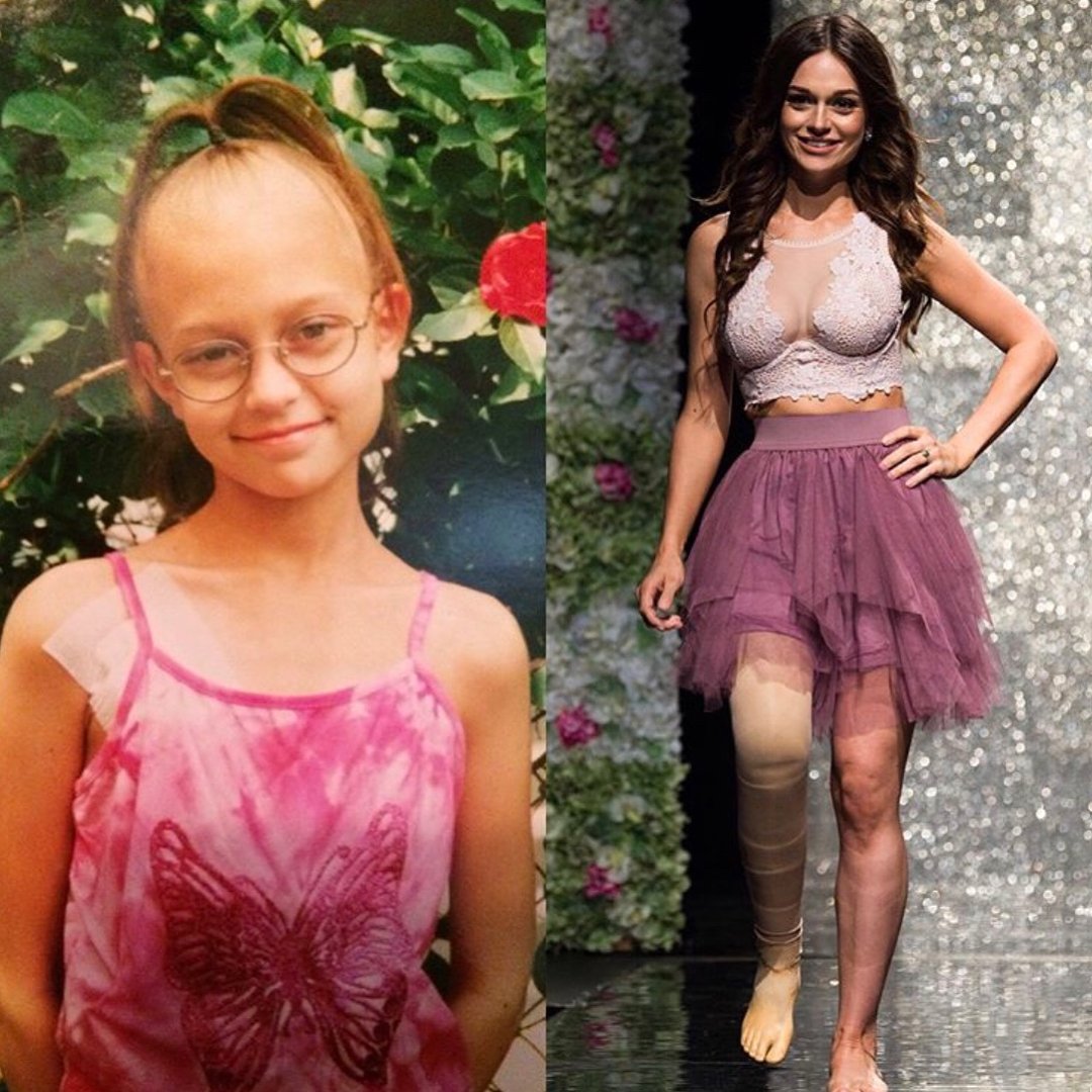 A 11 anni le amputano una gamba per il cancro, da grande diventa una modella