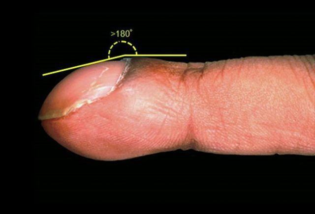 cosa-comportano-le-unghie-curve4