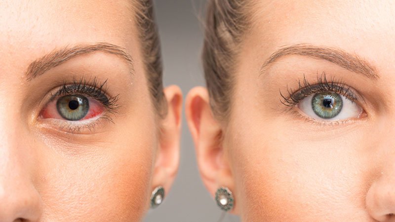 Congiuntivite: sintomi, cause e rimedi dell'occhio rosa