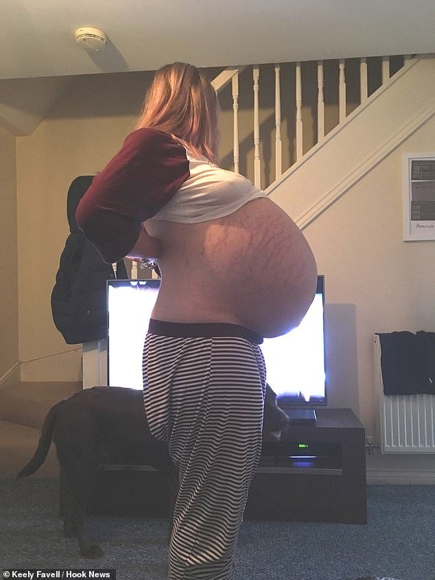 Pensavano fosse incinta ma aveva un "alieno" dentro lo stomaco