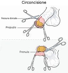 circoncisione-bambino