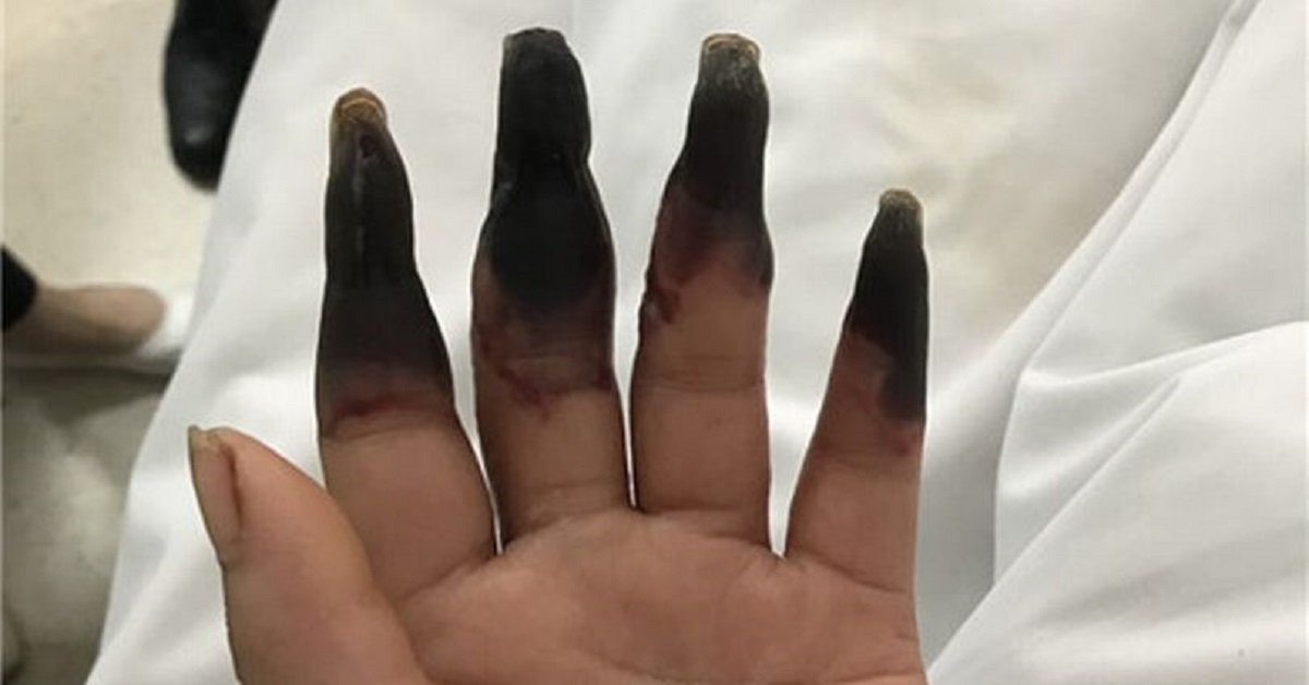 Le dita di una donna diventano nere dopo aver pulito casa