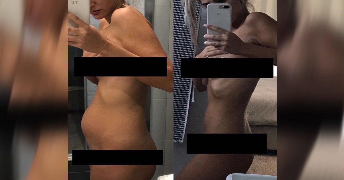Il mio corpo dopo l’endometriosi