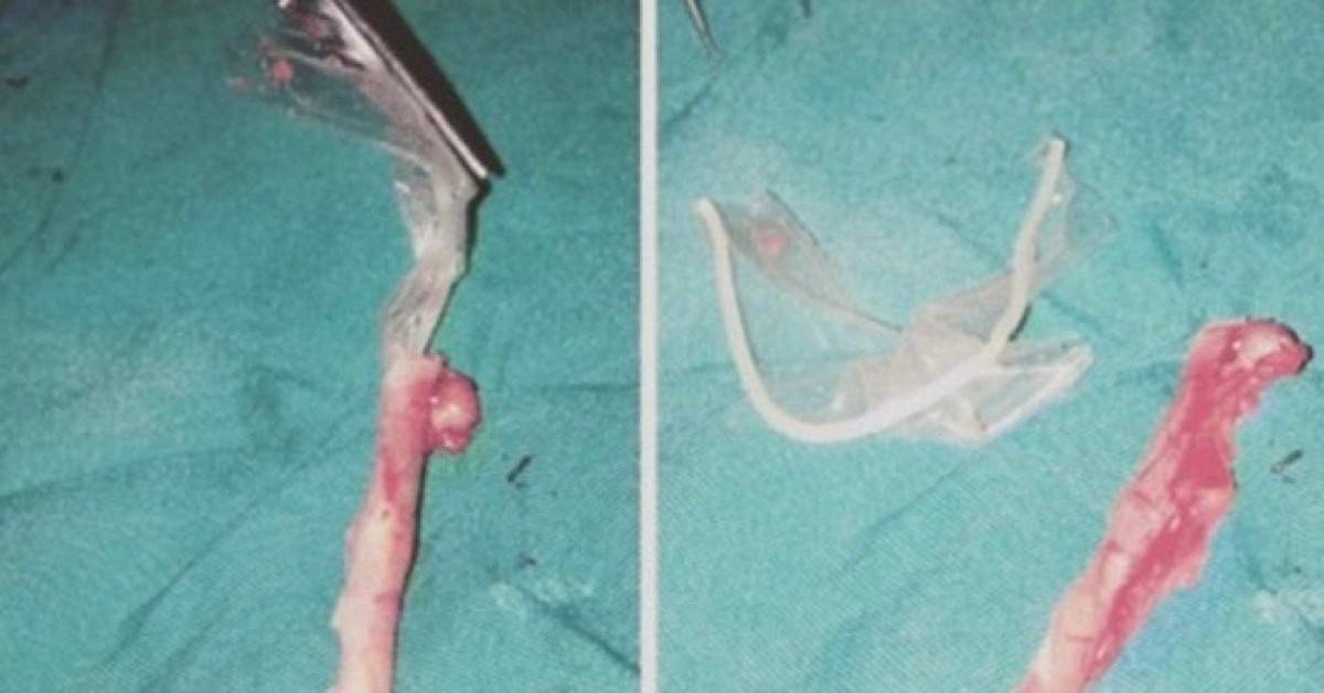 Operano la ragazza di appendicite, ma dentro al suo corpo c’è altro