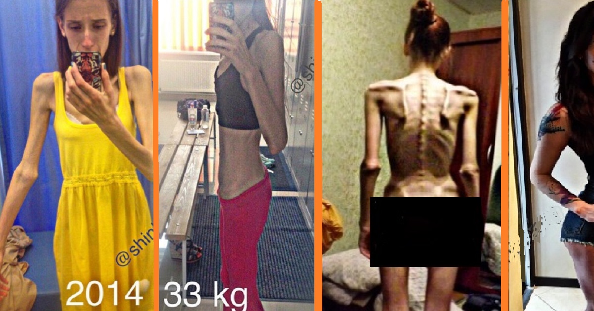 Dall’anoressia alla massa muscolare