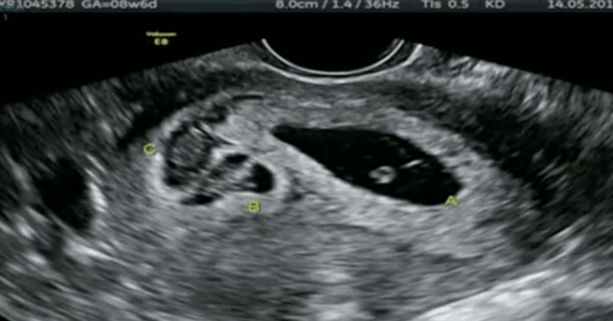 Dottore vede un secondo bambino nell’ecografia, ma non è un gemello