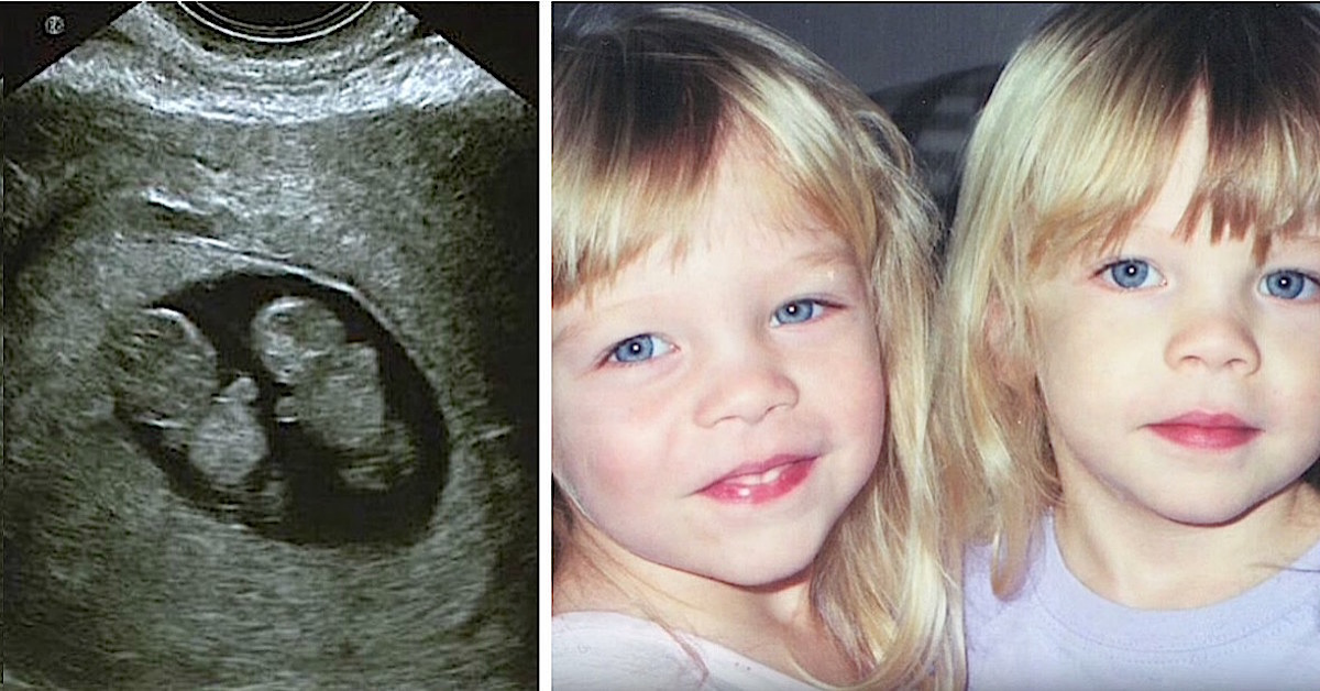 Il miracolo di Hailey, la gemellina in coma