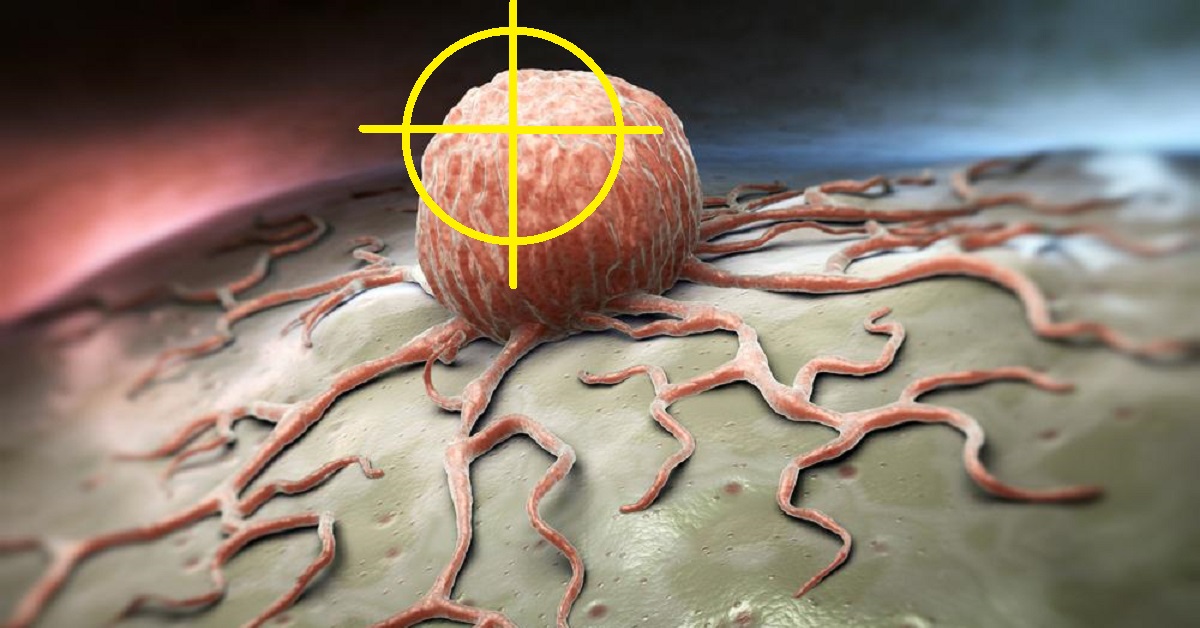 Scoperta nuova cura contro il cancro al seno